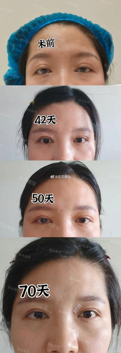 全切双眼皮恢复过程图 全切双眼皮恢复过程图 一个星期