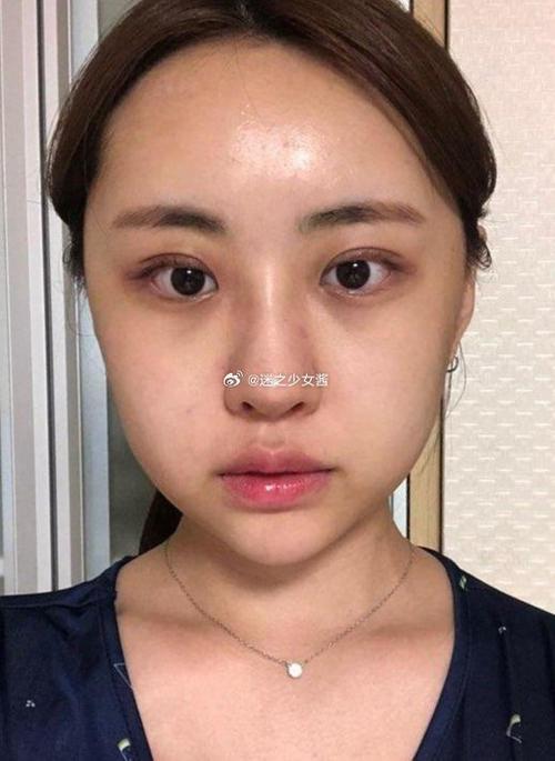 磨骨手术要花费多少钱 磨骨手术多少钱一次