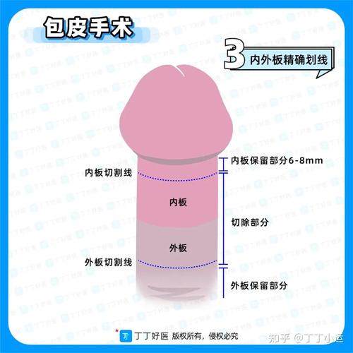 为什么要割包皮 割包切割手术多少钱啊