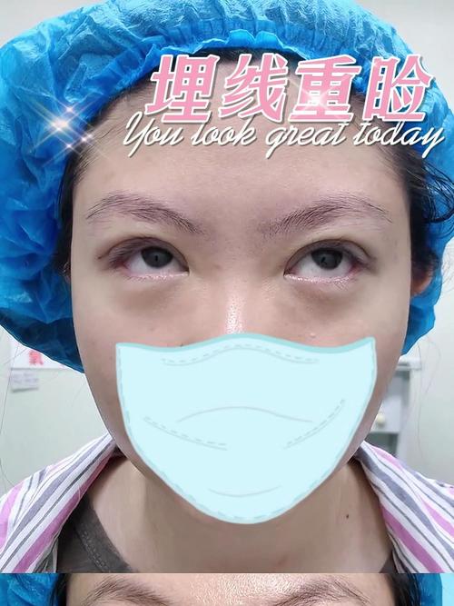 割双眼皮多少钱 双眼皮埋线价格大概多少钱