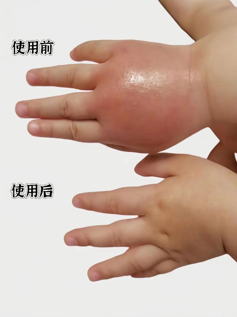 蚊子喜欢叮咬什么血型的人 身上抹什么蚊子不敢靠近