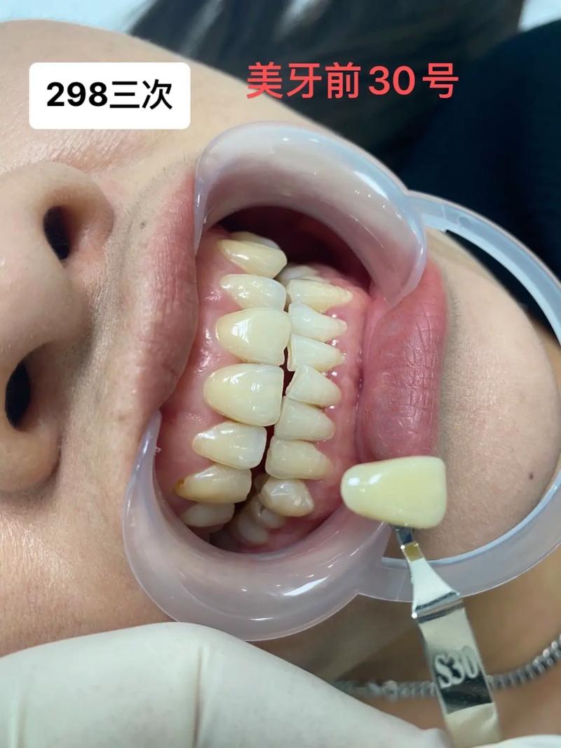如何让牙齿变白 怎么样能把牙齿变白