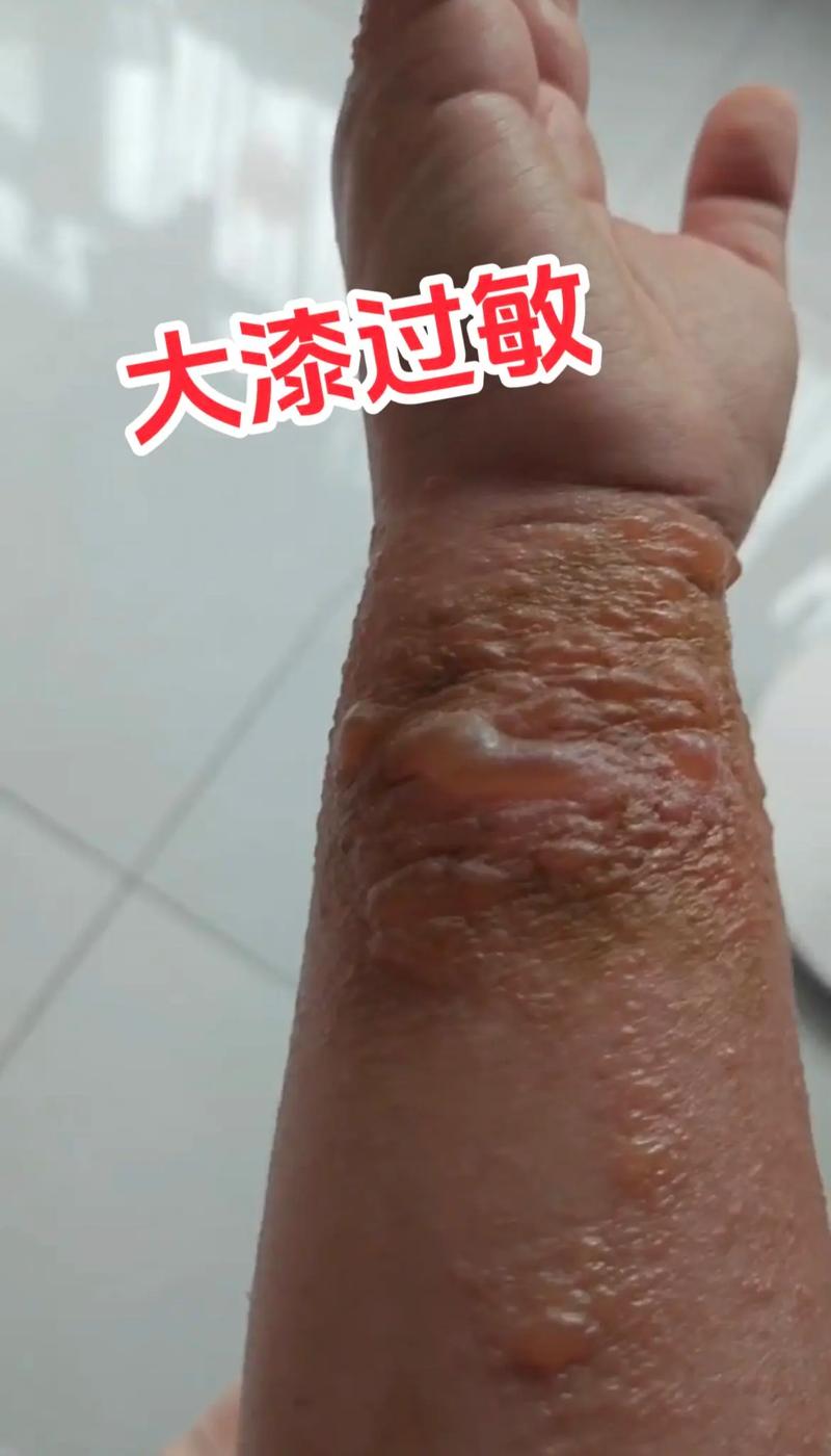 漆树过敏症状 漆树过敏特效药